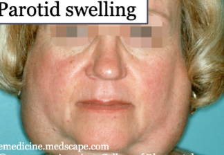 <p>which disease is associated with parotid swelling </p>