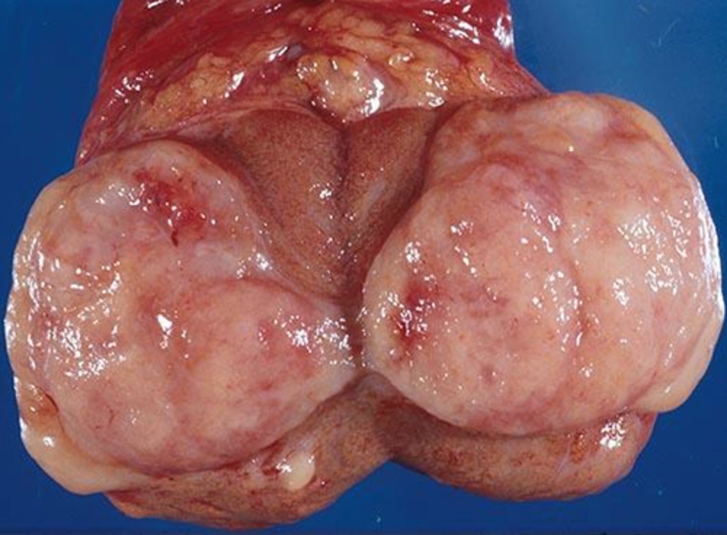 <p>seminoma</p>