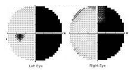 <p>describe this VF defect</p>