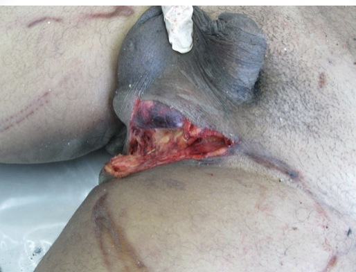 <p><span>ripping of skin and tissue from impact by or against object</span></p>
