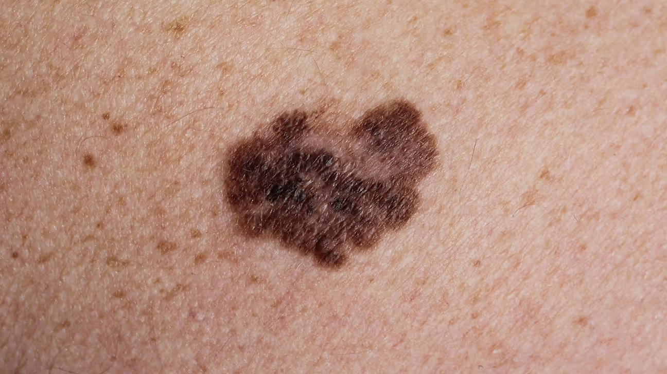 <p>A serious type of skin cancer that develops from melanocytes, appears as a dark mole/spot with irregular edges and spreads rapidly </p>