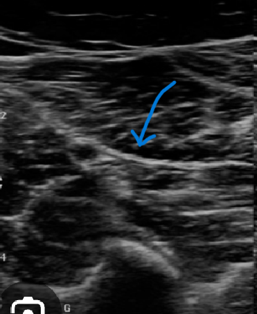 <p>Is the soleal muscle above or below the echogenic line?</p>