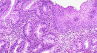 <p>Transformation of one tissue type to another</p>
