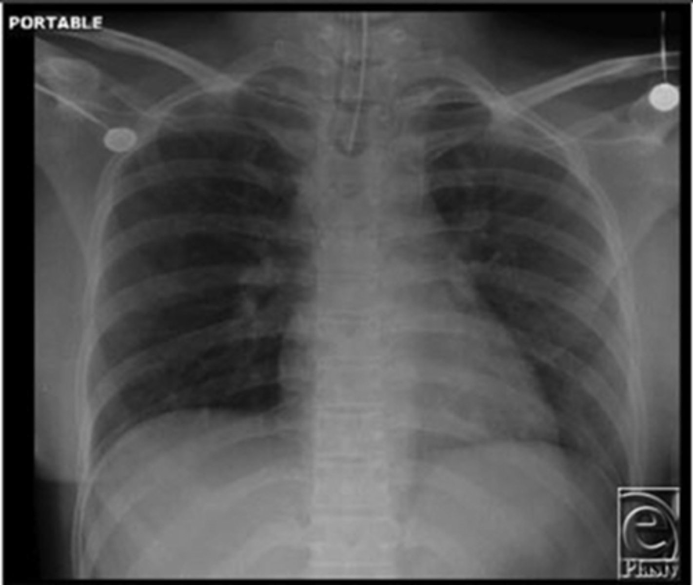 <p>What is going on in this CXR?</p>
