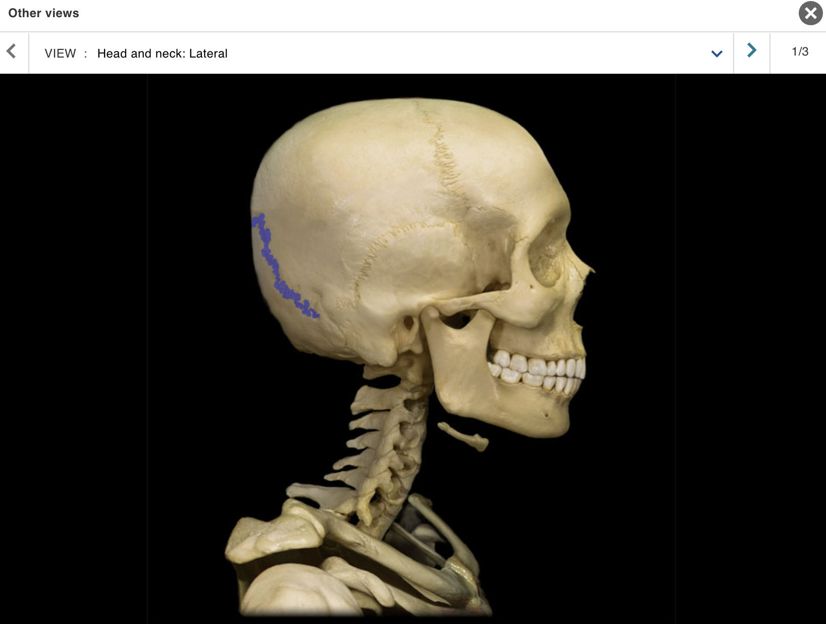 <p>Location:</p><p class="p1">• Skull (posterior)</p><p class="p1">Description:</p><p class="p1">• Joint between parietal and occipital bones</p>