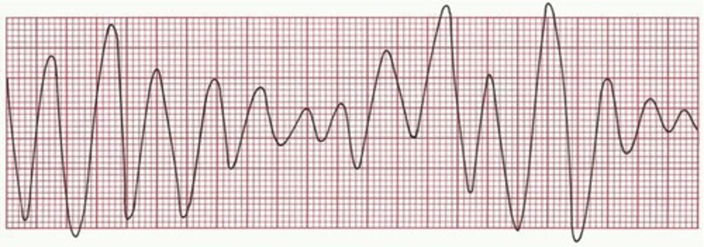 <p>hypomagnesium</p><p>hypokalemia</p>