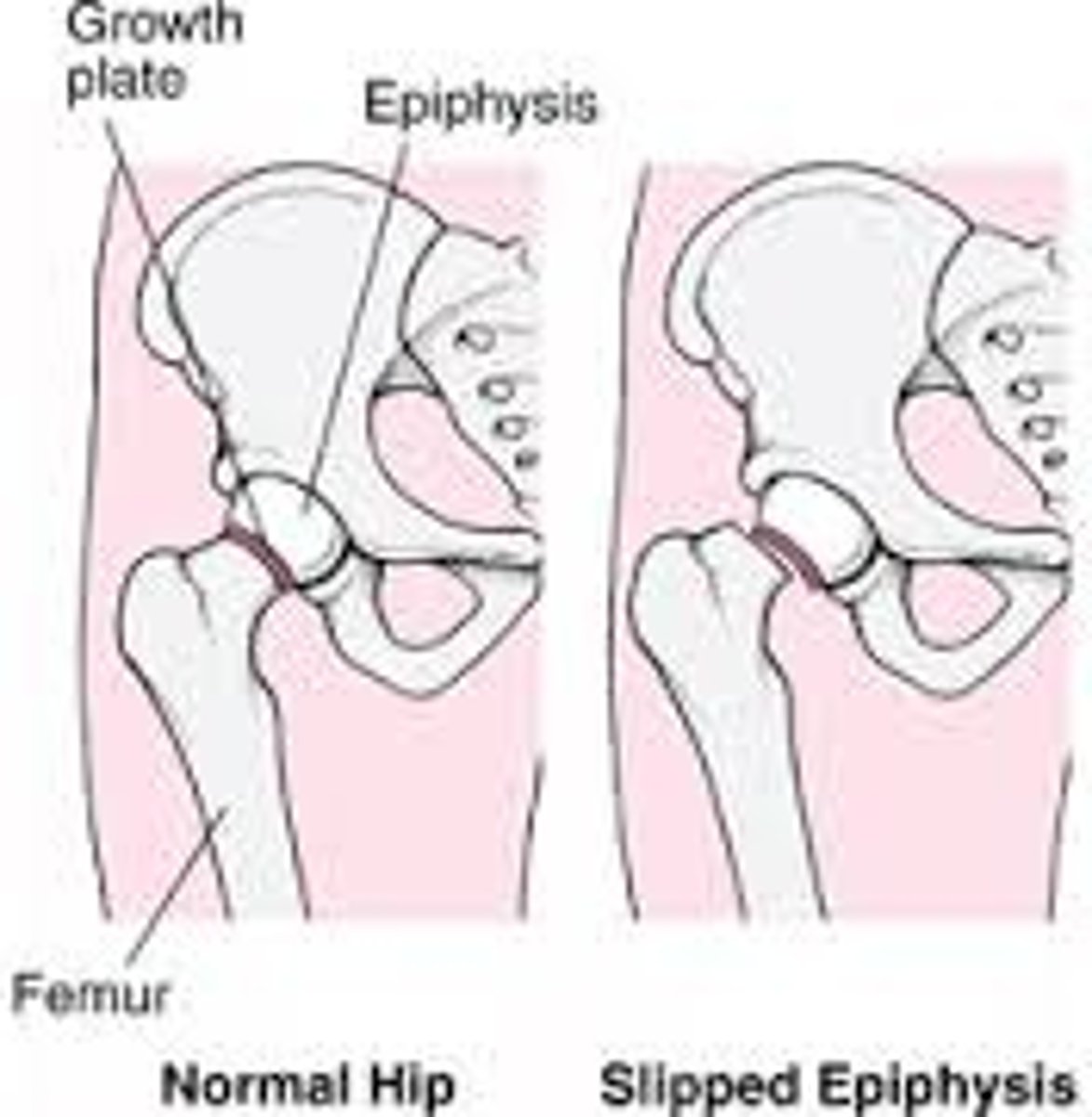 <p>- Posterior displacement of the capital femoral epiphysis from the femoral neck through the cartilage growth plate</p><p>- Causes limp and impaired internal rotation</p><p>- Occurs more in adolescents with obesity, suggesting that mechanical strain on the growth plate could be at least partially responsible for the slip. Endocrine factors also may be important.</p>