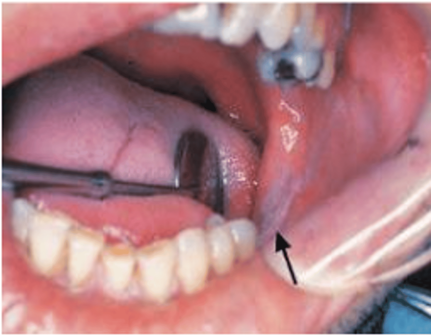 <p>chronic friction against mucosal surface</p>
