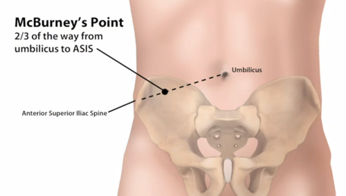 <p>Đường McBurney</p><p>Đoạn thẳng nối từ rốn đến gai chậu trước trên (anterior superior iliac spine)</p>