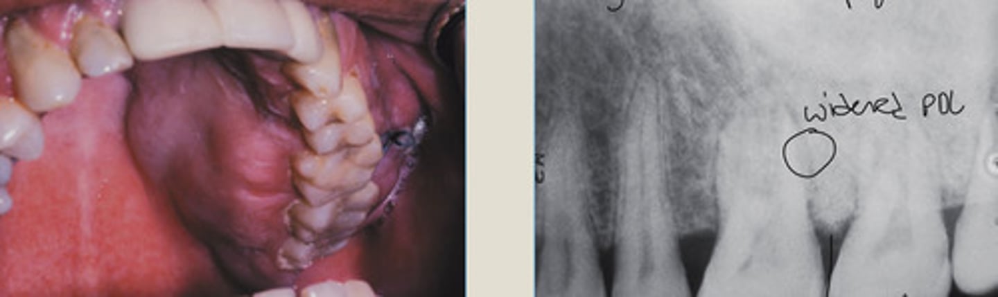 <p>Gradual &gt; more opaque bone pattern</p><p>Widened PDL</p><p>Firm painful swelling of the left maxilla</p>
