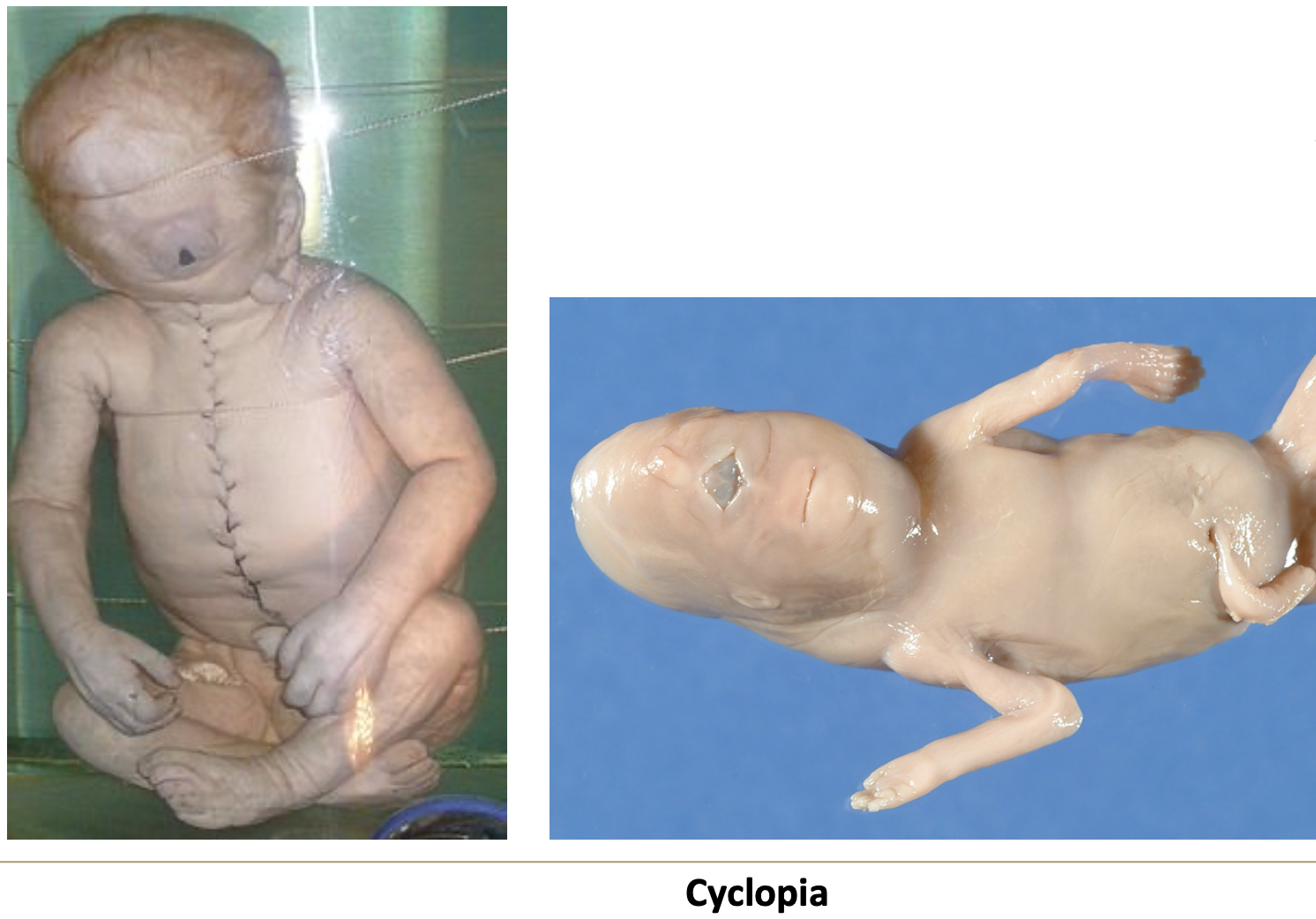 <p>Cyclopia — one central eye, due to teratogens or mutations in developmental genes.</p>