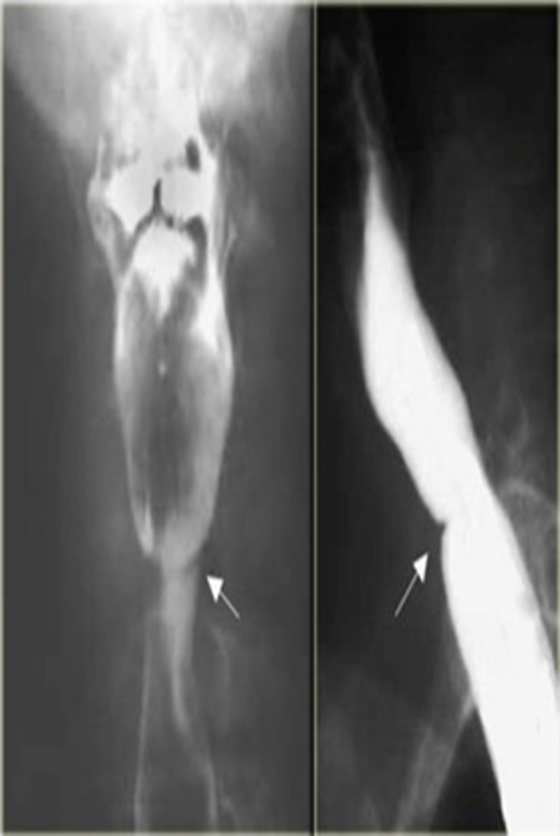 <p>Plummer-Vinson syndrome</p>