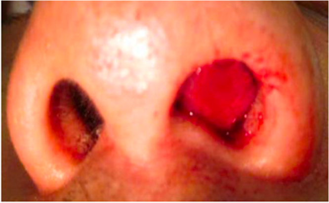 <p>blood accumulation between septal cartilage and mucoperichondrium</p>