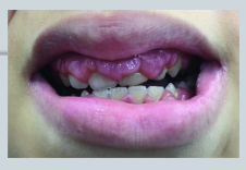 <p>Example – Gingival Swelling </p>