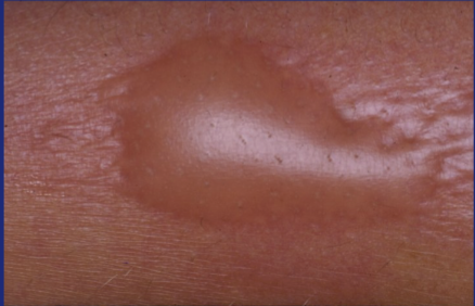 <p>A larger blister >5mm</p>