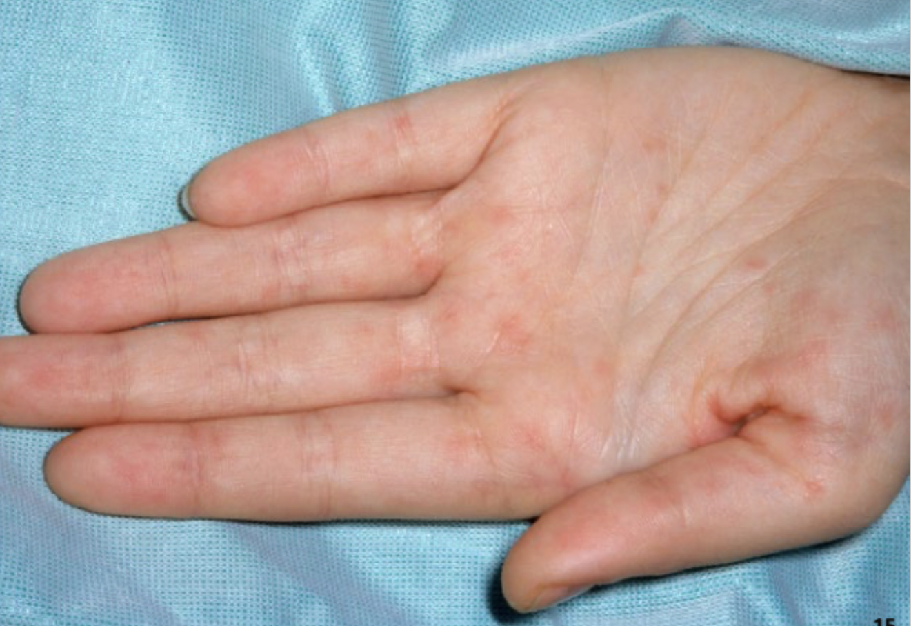 <p>A lumberjack from Arkansas presents to your office for flu like symptoms (fever, HA, malaise, and muscle aches). He also reports N/V and abd pain. On physical exam you note a blanching rash all other even the palms and soles. What is your treatment plan?</p>