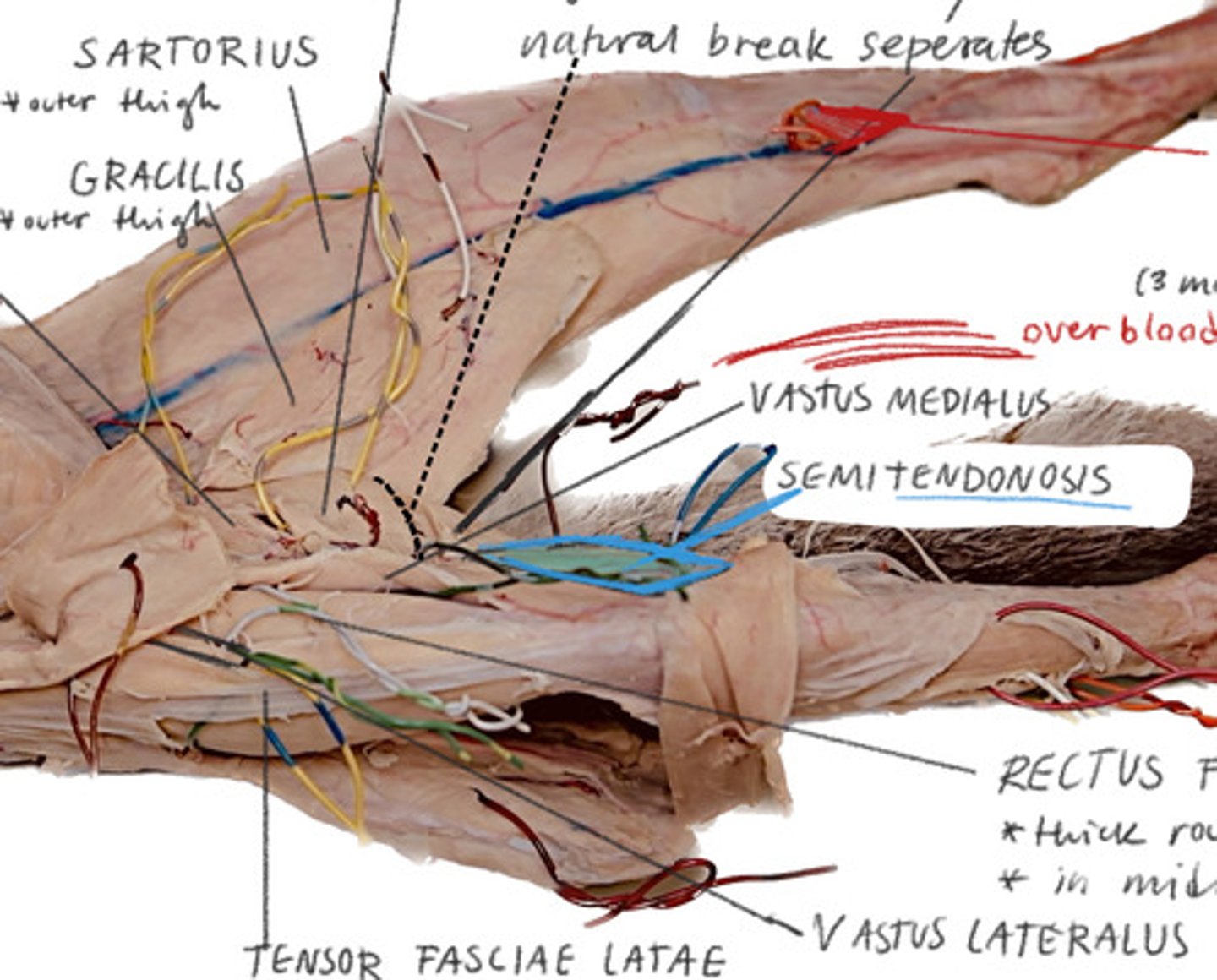 <p>Underneath the sartorius flap</p>