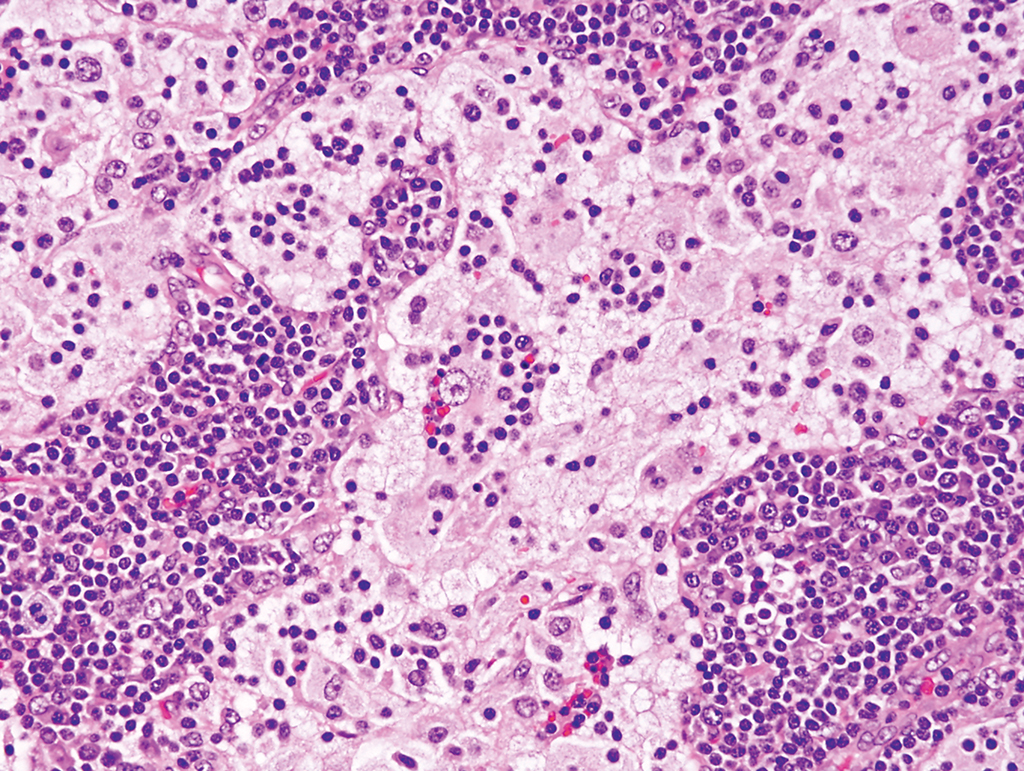 <p>Patient de 30 ans, ganglion élargi</p><p>1) Diagnostic </p><p>2) Localisation, population </p><p>3) Histologie </p><p>4) IHC</p><p>5) Moléculaire </p>