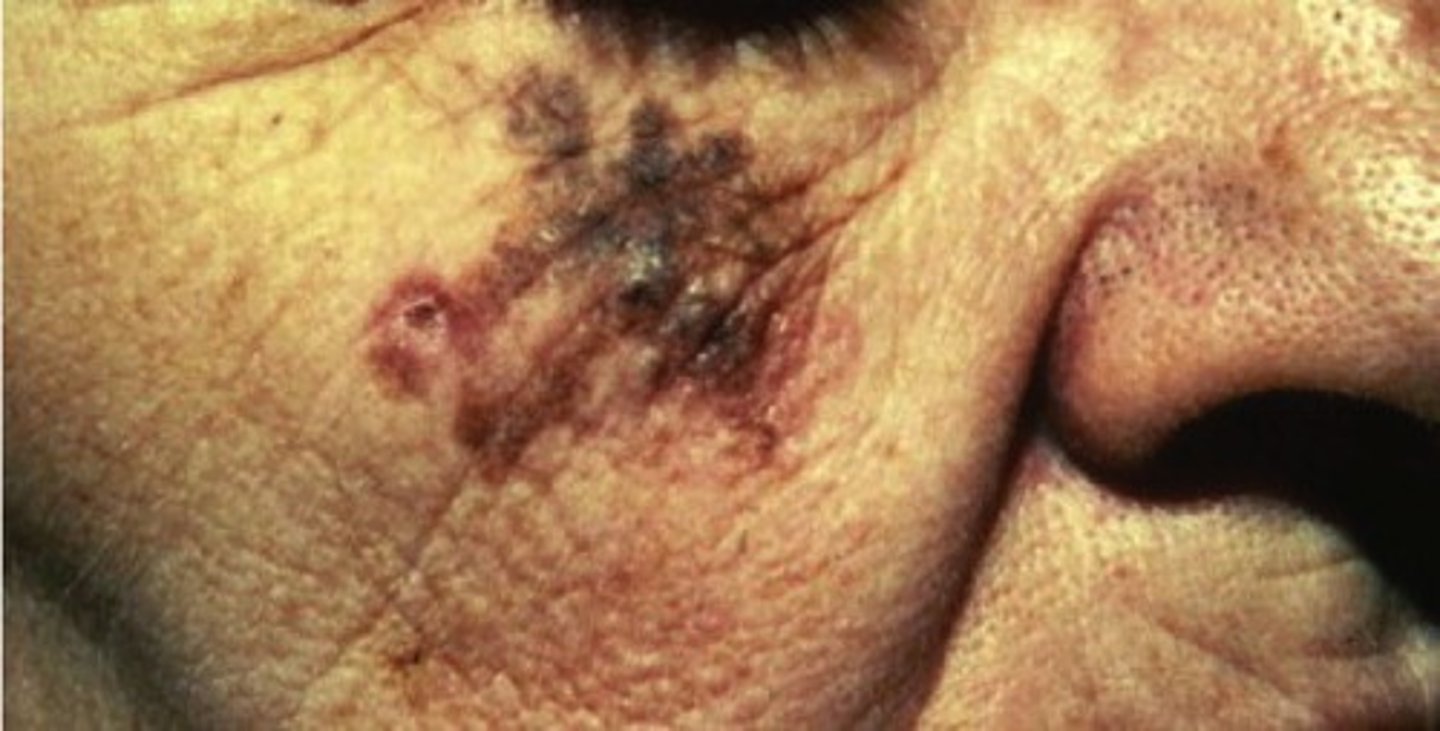 <p>Melanoma that occurs on chronically sun damaged skin </p><p>More common in elderly </p><p>Slow progression </p><p>Tumor spreads horizontally, not vertically </p><p>Face, neck, dorsum of hands</p>