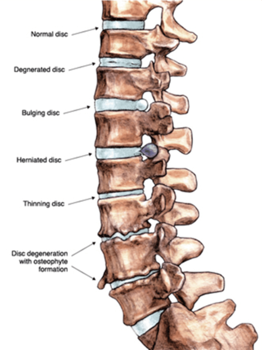<p>State the radiographic features of degenerative lumbar disc disease</p>