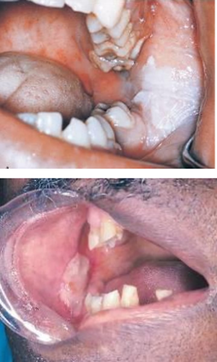 <p>chemical burn</p><p>aspirin in contact with mucosa for a period of time</p>