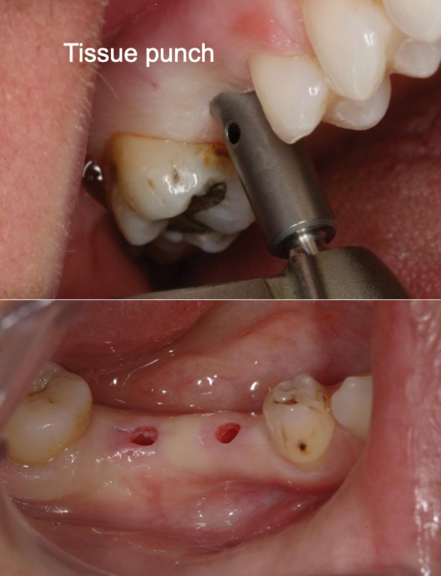 <p>What are the <strong>advantages</strong> of a flapless surgery?</p>