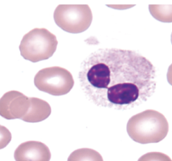 <p>what nuclear abnormality is associated with the following:</p><ul><li><p>myelodysplastic syndromes</p></li><li><p>asynchrony of nuclear maturation </p><ul><li><p>very clumped chromatin</p></li></ul></li></ul><p></p>