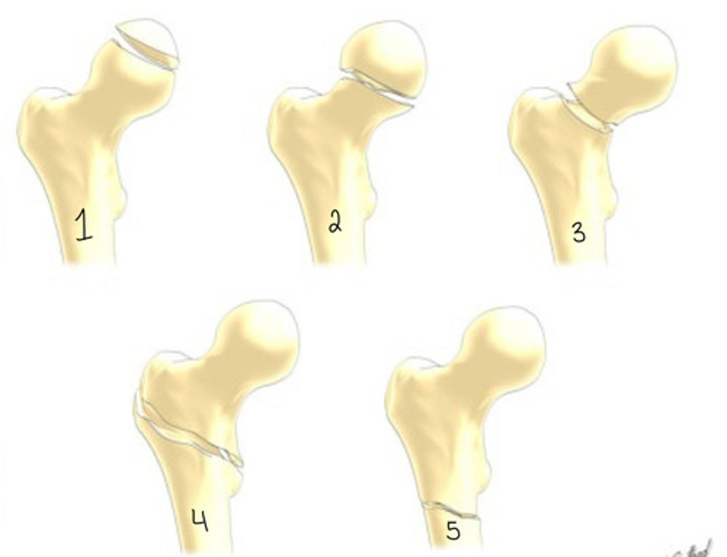<p>What type of fracture is 4?</p>