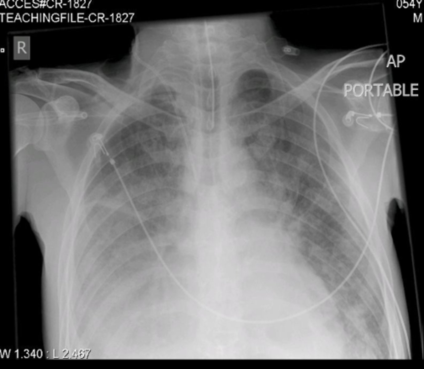 <p>chest x-ray</p>