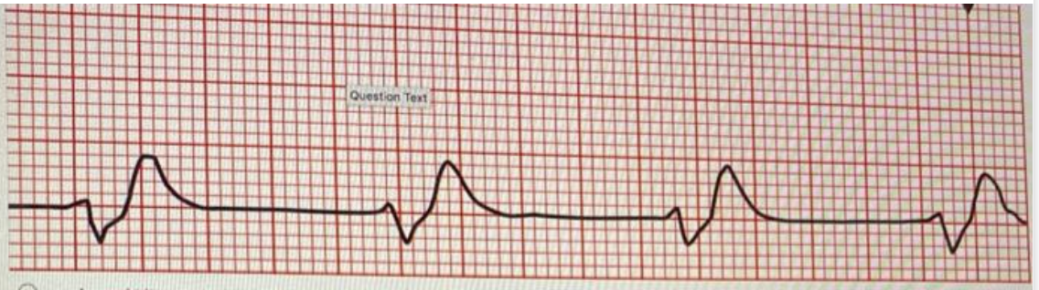 <p>How do you treat an idioventricular rhythm?</p>