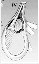 <p>Type IV SLAP lesion</p>