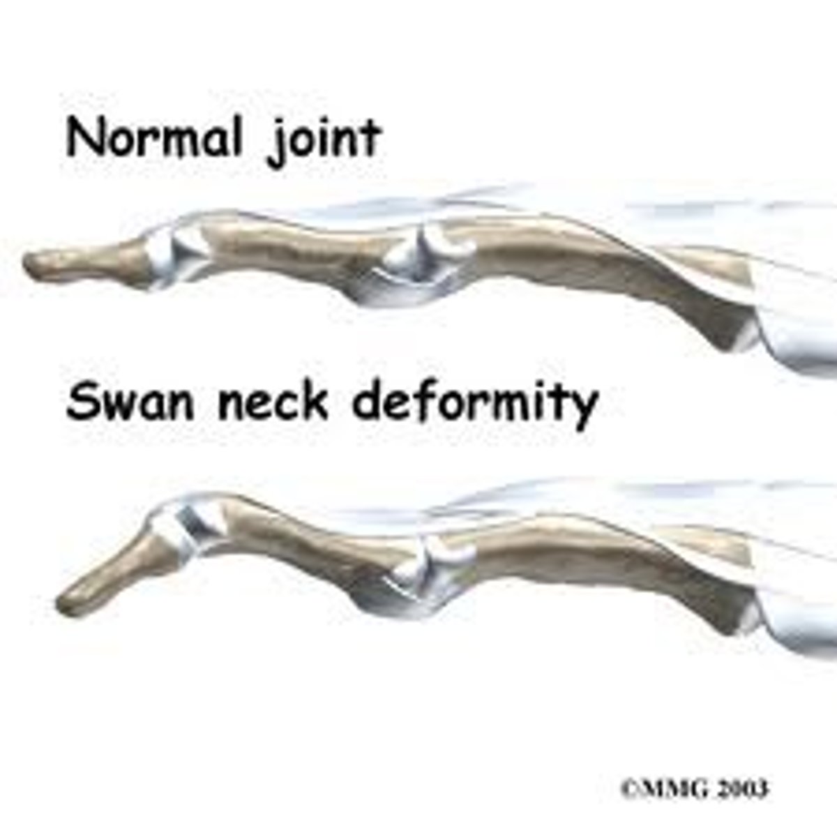 <p>PIP hyperextension and DIP flexion</p><p>dorsal displacement of lateral bands</p>