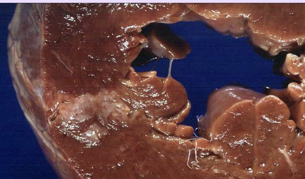 <p>Granulation tissue</p>