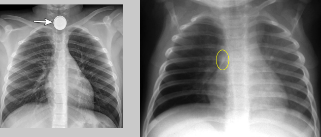 <p>What pathology is present?</p>