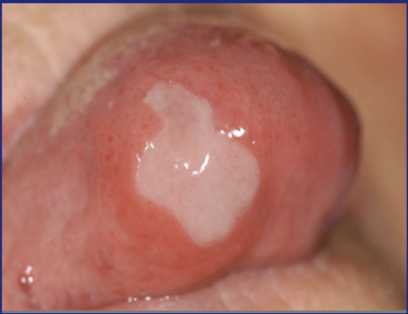 <p>‘Partial loss of surface epithelium without underlying exposure of deep layers or connective tissue</p>