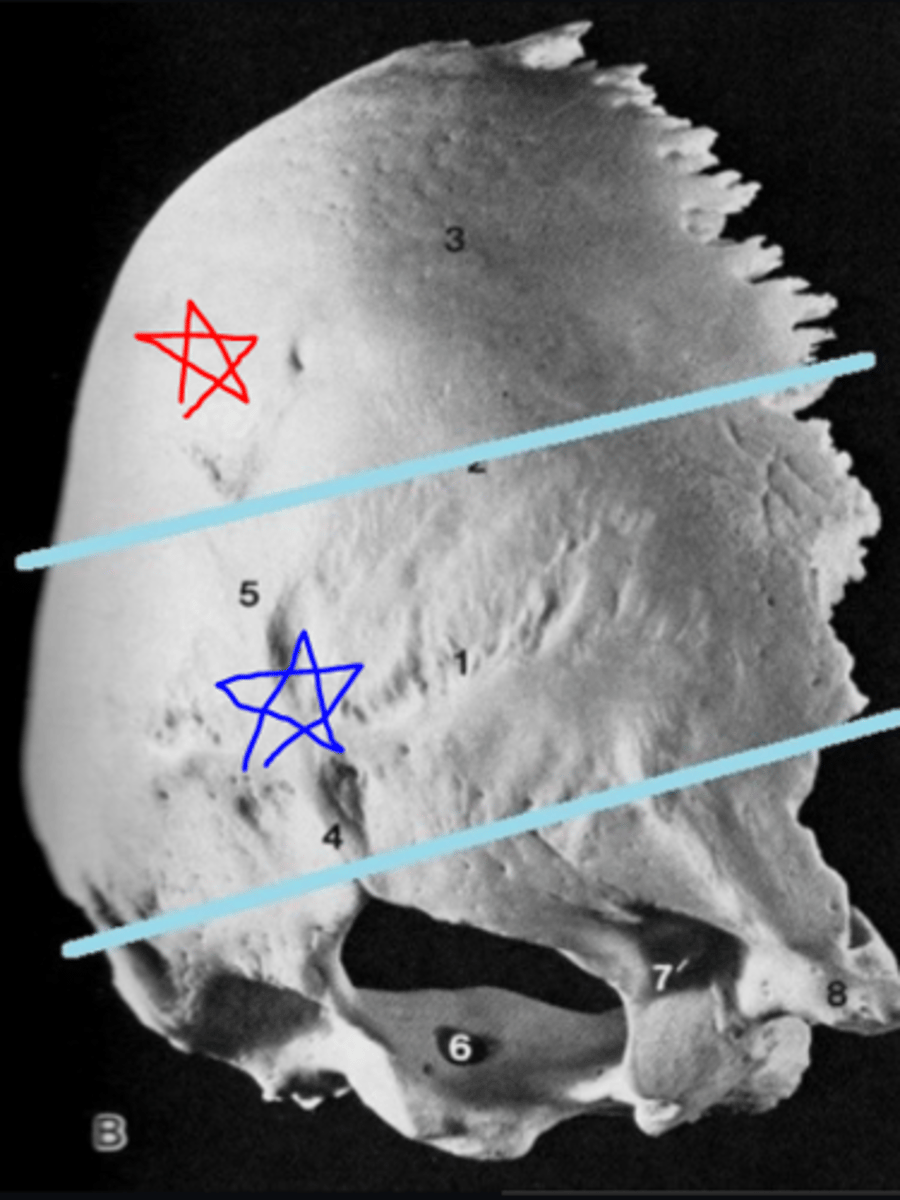 <p>part of OCCIPITAL squamous portion that lies above the superior nuchal lines (red star)/ section of squamous portion inferior to the lines (blue star)</p>