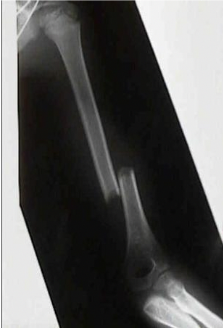 <p>Perte de flexion</p>
