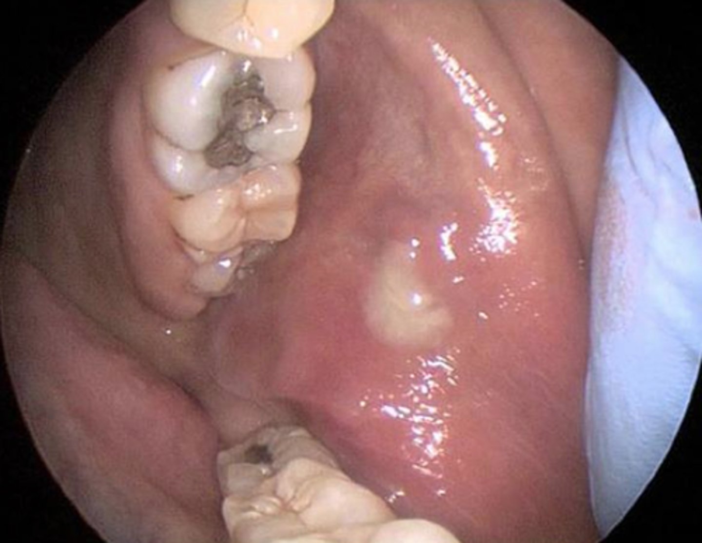 <p>inflammation of salivary glands from dehydration, stones, or poor oral hygiene</p>
