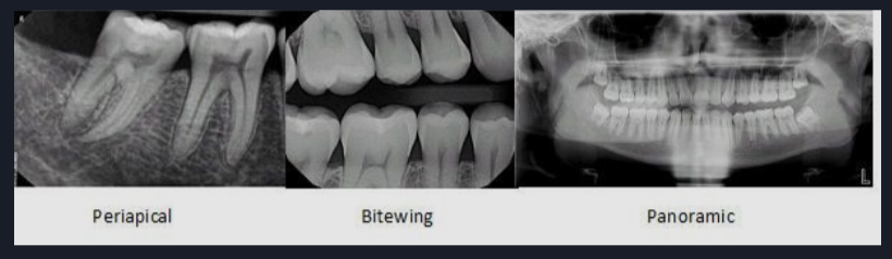 <p>Bitewing X-rays</p><p>Periapical X-rays</p><p>Occlusal X-rays</p>