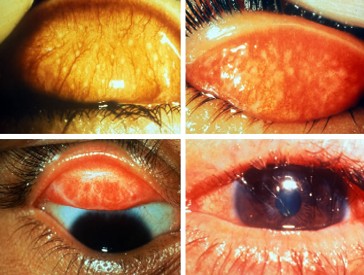 <ul><li><p><span>Caused by the <strong>bacterium Chlamydia</strong></span><span style="color: red"><strong> trachomatis&nbsp;</strong></span></p></li><li><p><span>Spread by direct contact with eye, nose and throat secretions from affected individuals or items they have used</span></p></li><li><p><span>Also spread by flies</span></p></li></ul><p></p>