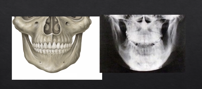 <p>hits the detector on the outside, where their face is </p><p>image would form something like this - this is a PA → posterior anterior mandible is </p>