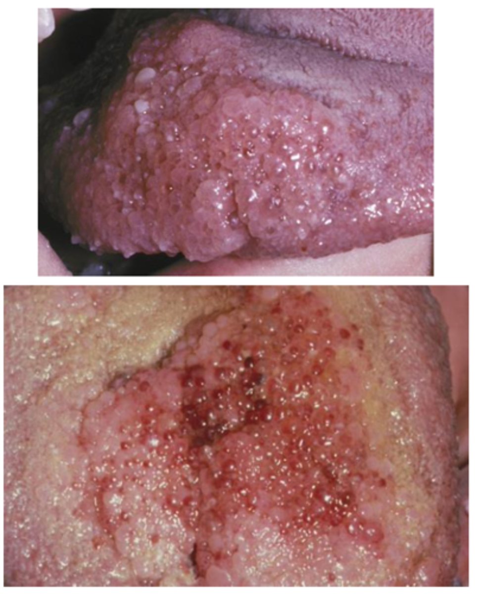 <p>• Predilection for the head and</p><p>neck</p><p>• Oral lymphatic malformations</p><p>are most frequent on the</p><p>anterior two thirds of the</p><p>tongue, where they often result</p><p>in macroglossia</p><p>• Demonstrates a pebbly surface</p><p>that resembles a cluster of</p><p>translucent vesicles</p>