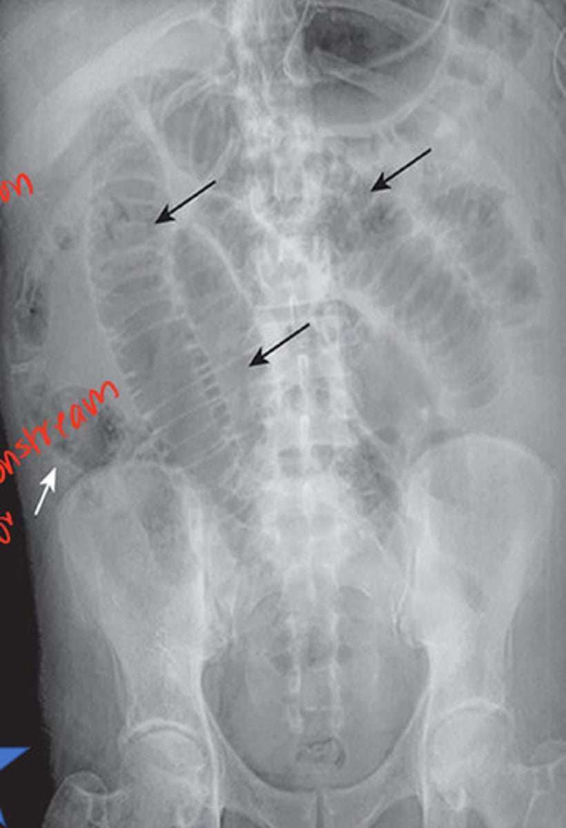 <p>overall bowel gas pattern is a pattern of disproportionate dilation of multiple loops 2/2 adhesions</p>