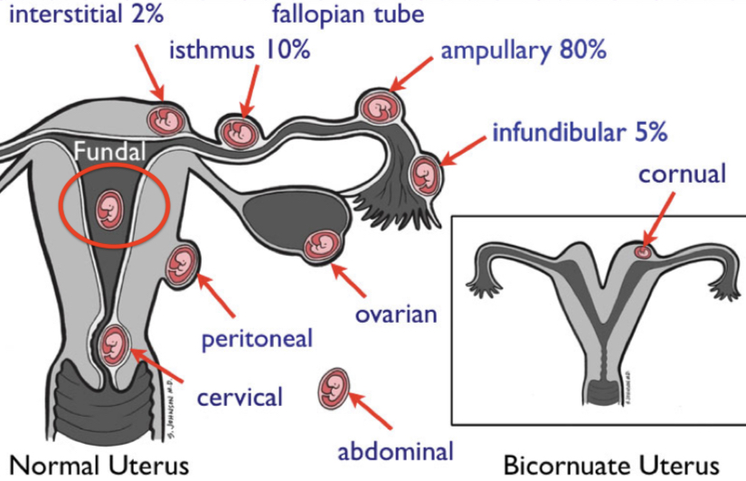 <p>Ampullary pregnancy </p>