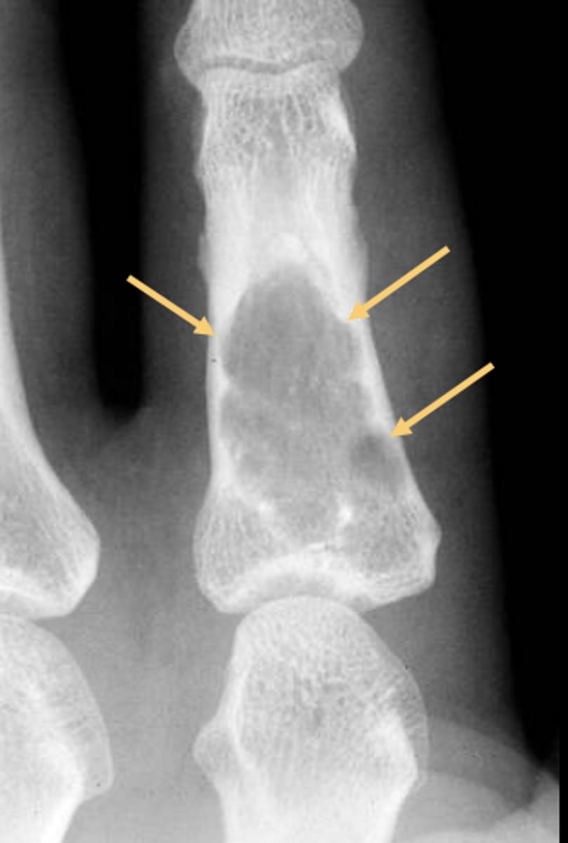 <p>ID feature of solitary enchondroma</p>