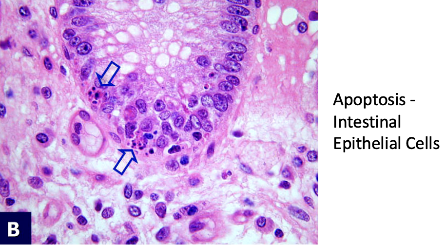 <p>Nuclear appearance in Cell Death (Necrosis vs Apoptosis)</p>