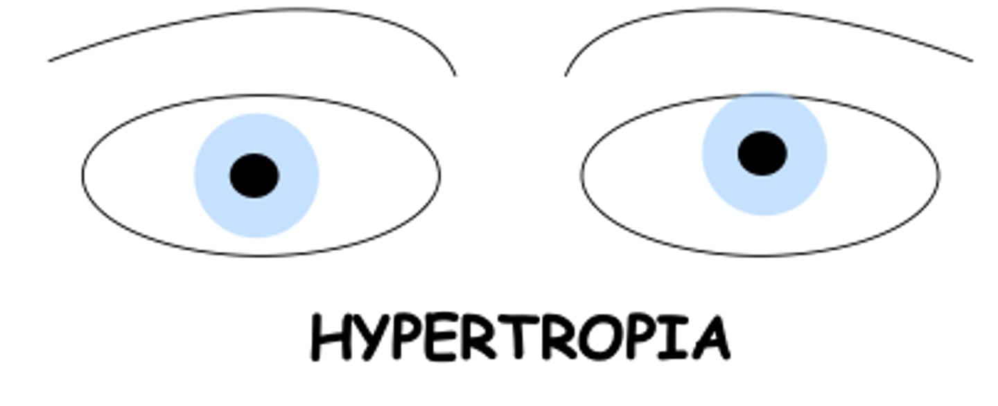 <p>one eye deviates upward compared to the other</p>