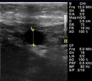 <p><span>This is AP diameter measurement of the vein.&nbsp;</span></p>