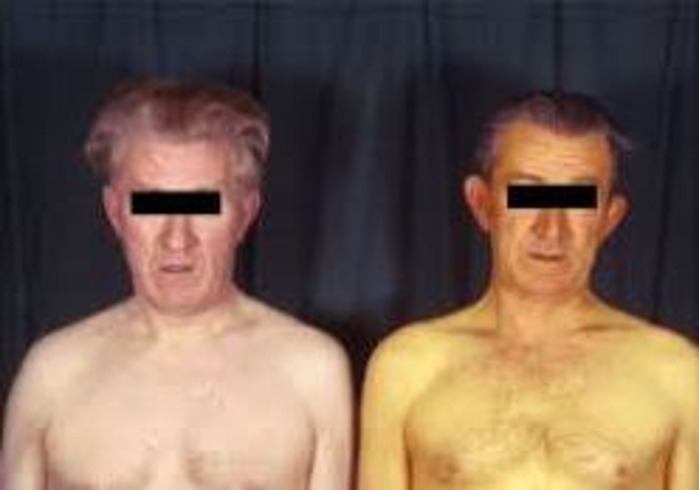 <p>liver disorder, yellow bile pigments accumulate in blood and are deposited into tissues</p>