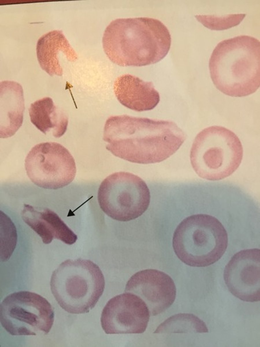 <p>- Crystals are irregular shaped</p><p>- Partially HbS and partially HbC</p><p>* Diagnostic for HbSC</p><p>- Child of person with traits for HbS and HbC</p>